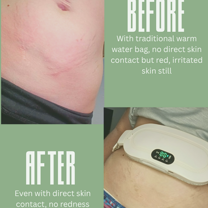 A before-and-after comparison collage showing a person's lower abdomen with skin irritation on the left and a white digital heating pad applied on the right. Text on a sage green background explains the comparison, with the after image showing reduced redness and irritation.